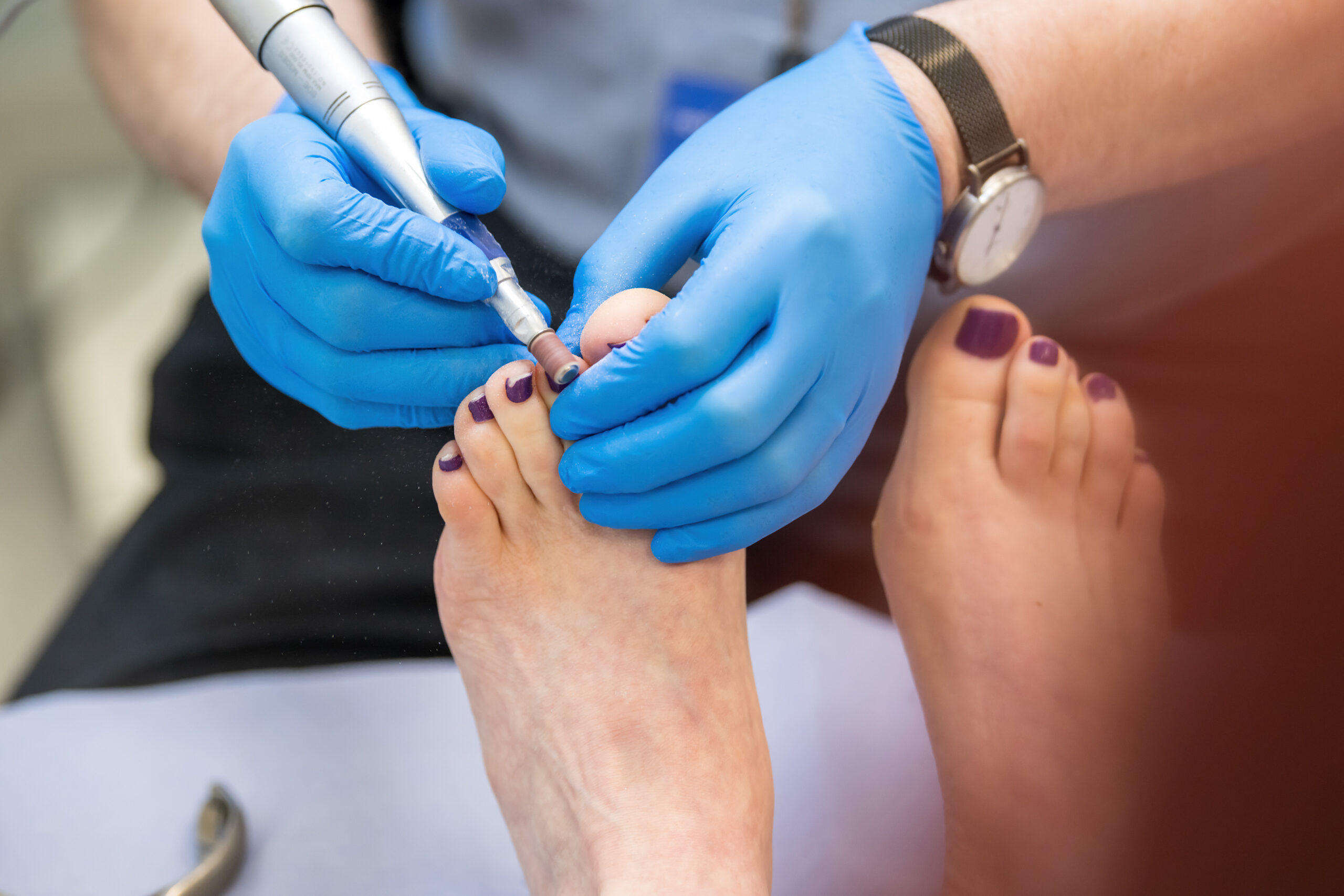A podiatrist wearing blue latex gloves is working on a woman's feet with a metal tool. The women's toenails are painted dark purple.